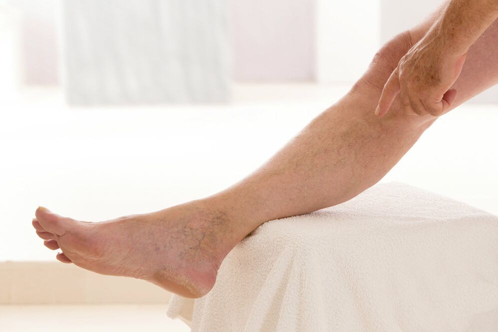 varicose veins on the legs